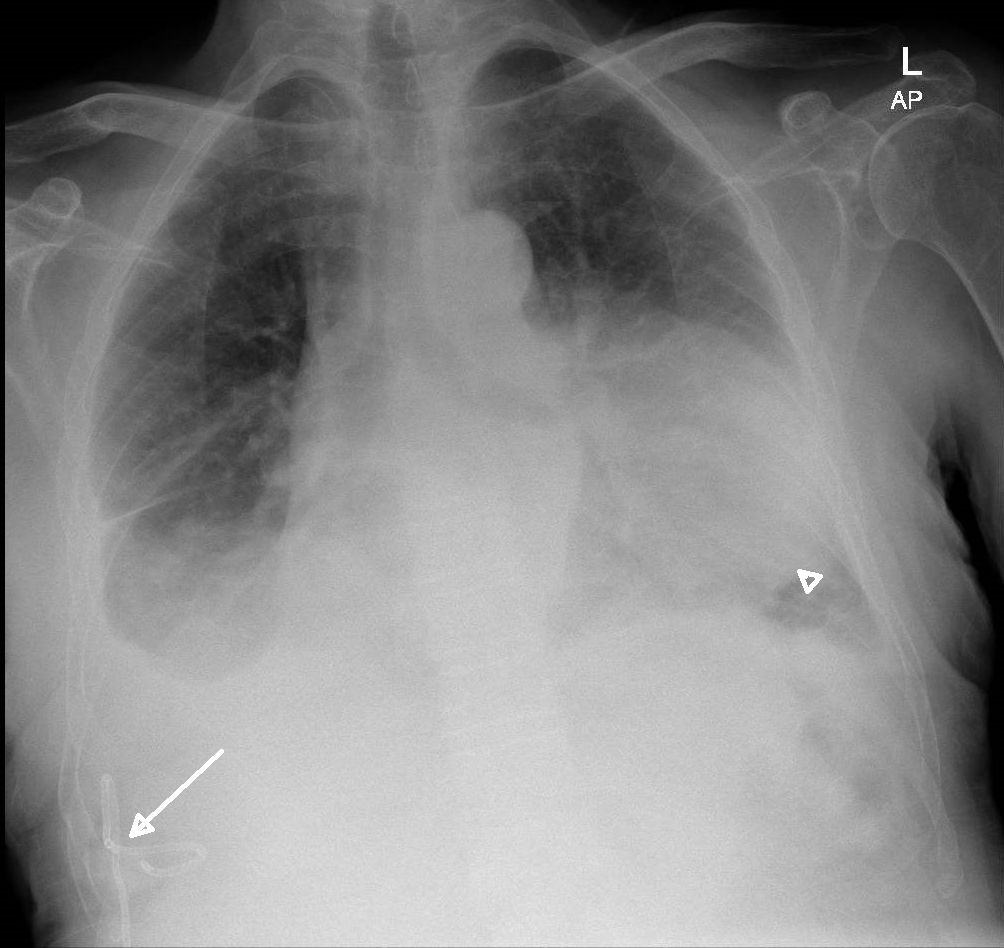 Figure 1: Chest radiograph showing a pigtail catheter on the right side (arrow), bilateral pleural effusions and a metastatic mass left lower zone (arrowhead).